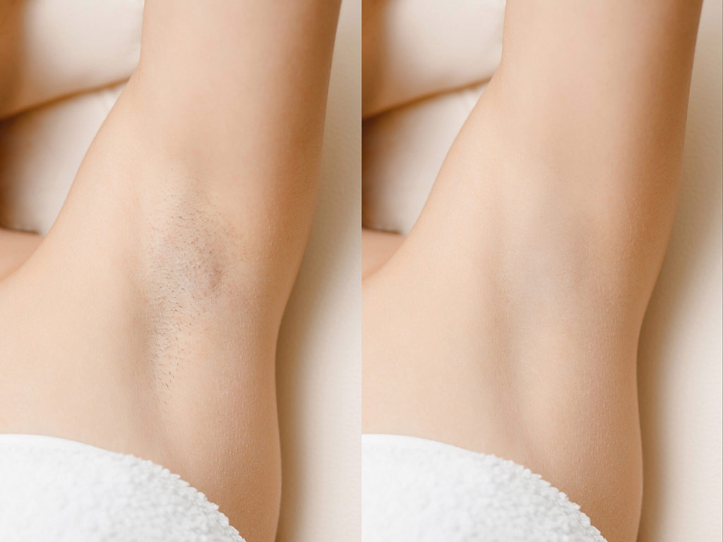Underarms-Laser-Hair-Removal-in-Winnipeg
